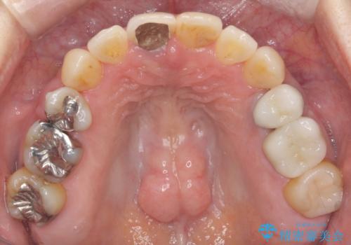 50代女性 八重歯を矯正治療 歯並びの中等度のがたつきの治療後