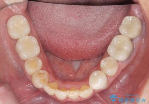 50代女性 八重歯を矯正治療 歯並びの中等度のがたつきの治療後