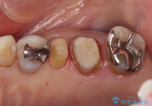 70代女性 段差のある被せ物のやり替え