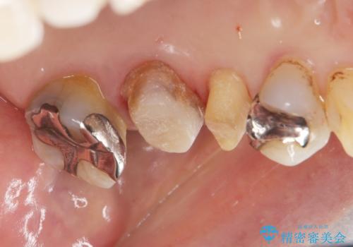 70代女性 段差のある被せ物のやり替え の治療中