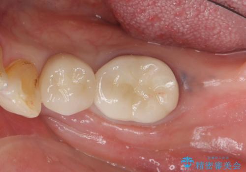 70代女性 段差のある被せ物のやり替え の治療後