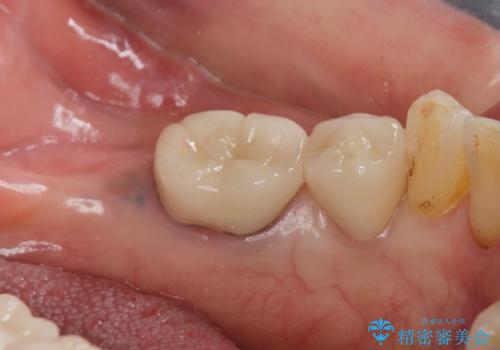 70代女性 段差のある被せ物のやり替え の治療後