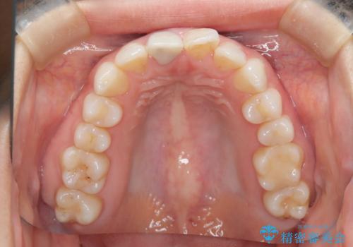 根管治療と並行して矯正を マウスピース治療の治療前