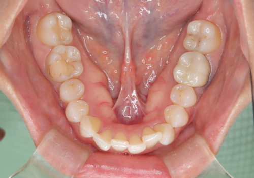 根管治療と並行して矯正を　マウスピース治療の治療前
