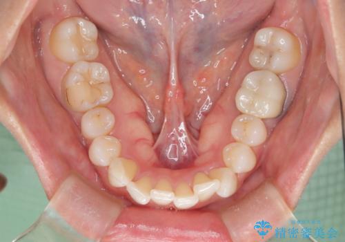 根管治療と並行して矯正を マウスピース治療の治療前