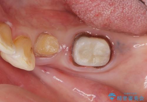 70代女性　段差のある被せ物のやり替え　の治療中