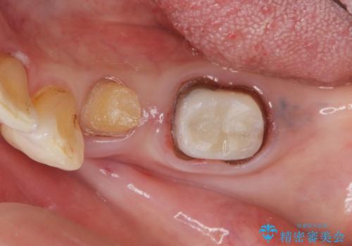 70代女性 段差のある被せ物のやり替え の治療中