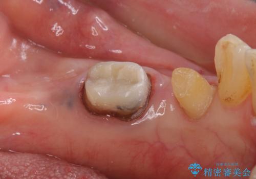70代女性 段差のある被せ物のやり替え の治療中