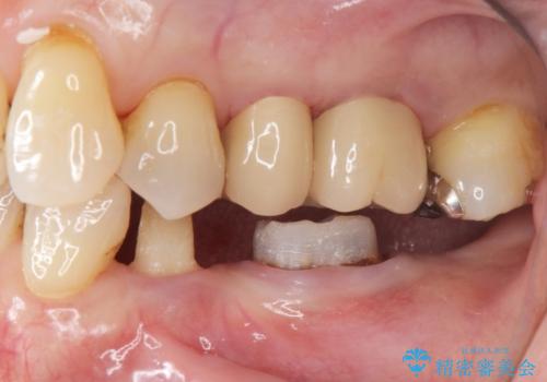 70代女性 段差のある被せ物のやり替え の治療中