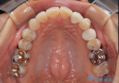 むし歯と前歯のデコボコを治したい　インビザラインを使用した総合歯科治療の治療中