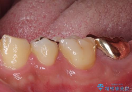 伸び出してきた上顎奥歯 部分矯正を用いた奥歯の補綴治療の治療後