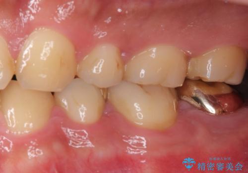 伸び出してきた上顎奥歯 部分矯正を用いた奥歯の補綴治療の治療後