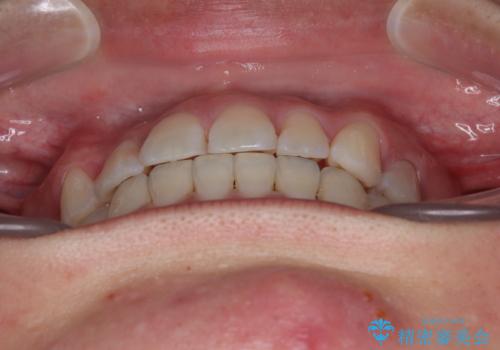 マウスピース矯正が煩わしい ワイヤー装置での非抜歯矯正の治療後