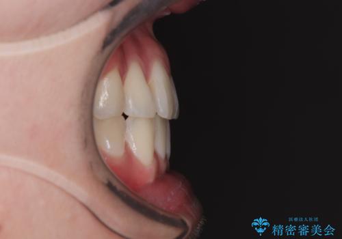 マウスピース矯正が煩わしい ワイヤー装置での非抜歯矯正の治療後