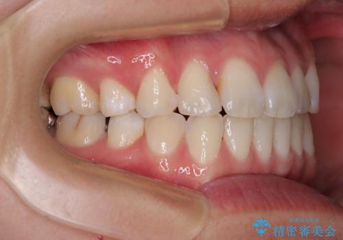 マウスピース矯正が煩わしい ワイヤー装置での非抜歯矯正の治療後