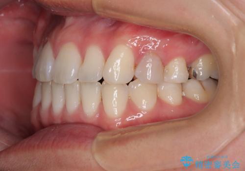 マウスピース矯正が煩わしい ワイヤー装置での非抜歯矯正の治療後