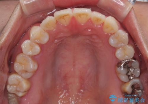 マウスピース矯正が煩わしい　ワイヤー装置での非抜歯矯正の治療後