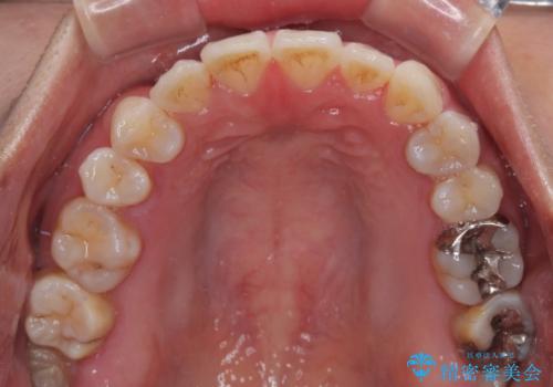 マウスピース矯正が煩わしい ワイヤー装置での非抜歯矯正の治療後