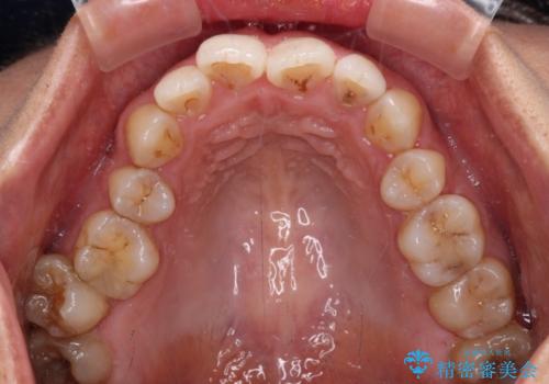 前歯のデコボコを改善　インビザラインの矯正治療の治療前