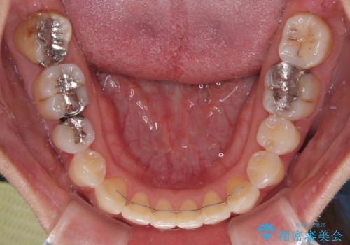マウスピース矯正が煩わしい ワイヤー装置での非抜歯矯正の治療後