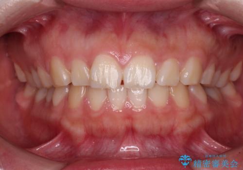 口元の突出感を治したい ワイヤー装置を用いた抜歯矯正の治療前