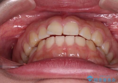 口元の突出感を治したい ワイヤー装置を用いた抜歯矯正の治療前