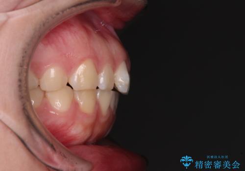 口元の突出感を治したい ワイヤー装置を用いた抜歯矯正