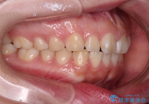 口元の突出感を治したい ワイヤー装置を用いた抜歯矯正の治療前