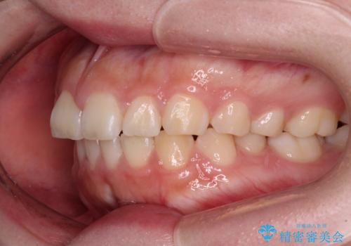 口元の突出感を治したい ワイヤー装置を用いた抜歯矯正の治療前