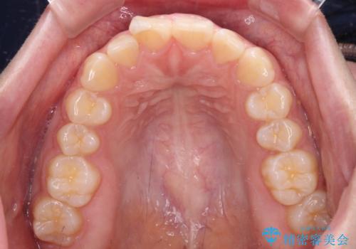 口元の突出感を治したい ワイヤー装置を用いた抜歯矯正の治療前