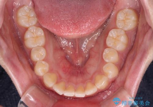 口元の突出感を治したい ワイヤー装置を用いた抜歯矯正の治療前