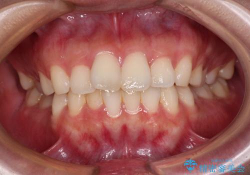 口元の突出感を改善したい。審美装置による抜歯矯正の症例 治療前