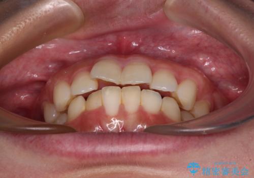 口元の突出感を改善したい。審美装置による抜歯矯正の治療前