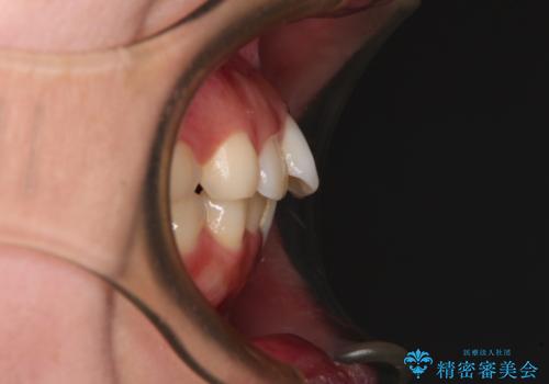 口元の突出感を改善したい。審美装置による抜歯矯正の治療前