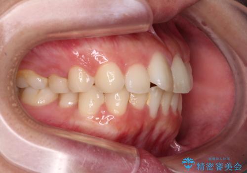 口元の突出感を改善したい。審美装置による抜歯矯正の治療前