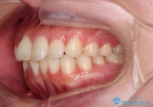 口元の突出感を改善したい。審美装置による抜歯矯正の治療前