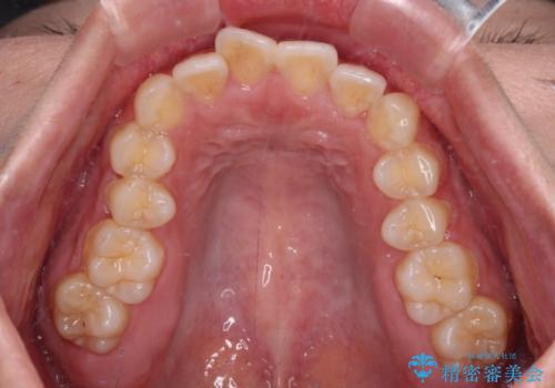 口元の突出感を改善したい。審美装置による抜歯矯正の治療前