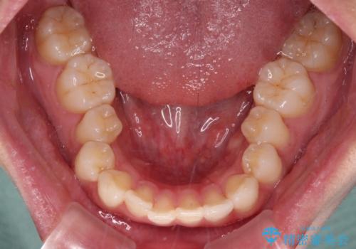 口元の突出感を改善したい。審美装置による抜歯矯正の治療前