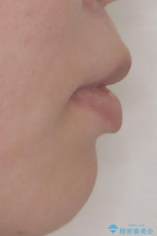口元の突出感を改善したい。審美装置による抜歯矯正の治療前(顔貌)