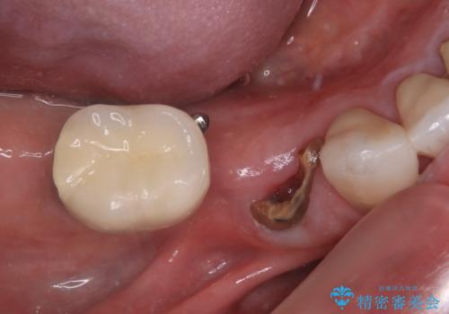 強い咬合力で歯が割れる 1DAYインプラントで歯を守りながら治療の症例 治療前