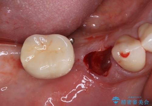 強い咬合力で歯が割れる 1DAYインプラントで歯を守りながら治療の治療中