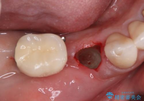 強い咬合力で歯が割れる 1DAYインプラントで歯を守りながら治療の治療後