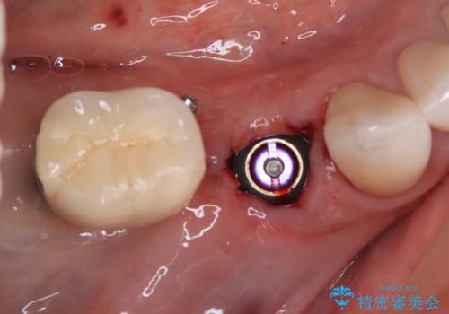 強い咬合力で歯が割れる 1DAYインプラントで歯を守りながら治療の治療中