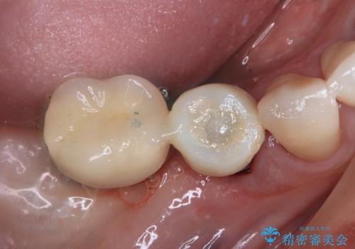 強い咬合力で歯が割れる 1DAYインプラントで歯を守りながら治療の治療中