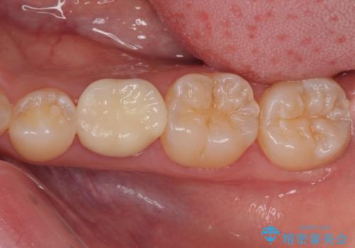 乳歯に虫歯ができた オールセラミッククラウンの症例 治療後