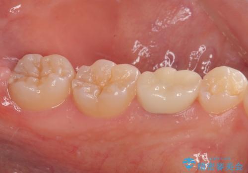 乳歯に虫歯ができた オールセラミッククラウンの治療後