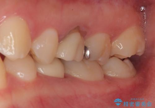 乳歯に虫歯ができた オールセラミッククラウンの治療後