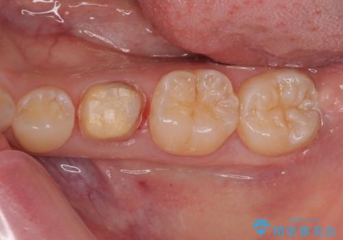 乳歯に虫歯ができた オールセラミッククラウンの治療中