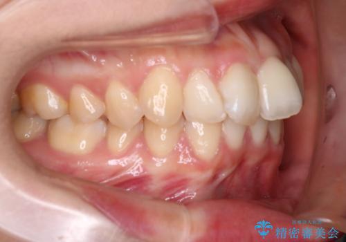 抜歯矯正×インビザライン|上下のバランスを整え、美しい歯並びへの治療前