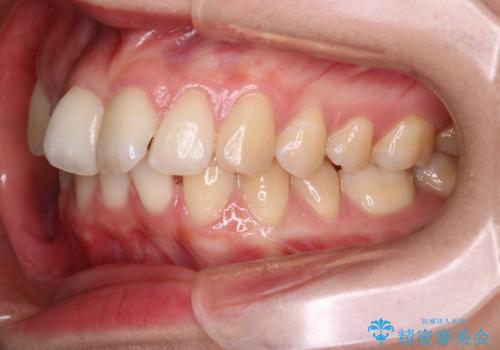 抜歯矯正×インビザライン|上下のバランスを整え、美しい歯並びへの治療前